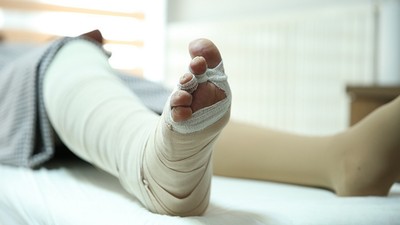 Gizli salgın 'lenfödem'e karşı daha az yağlı besin, daha fazla egzersiz