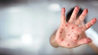 ABD'nin Texas eyaletindeki kızamık salgınında vaka sayısı 624'e yükseldi