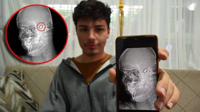 1,5 yıl önce başına isabet eden yorgun mermi hâlâ çıkarılamadı... Her gün ölüm korkusu yaşıyor