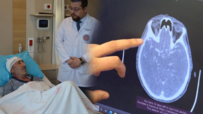 Atardamar ve toplardamarın beyinde oluşturduğu 'damar yumağı’nı 5 saatte temizlediler