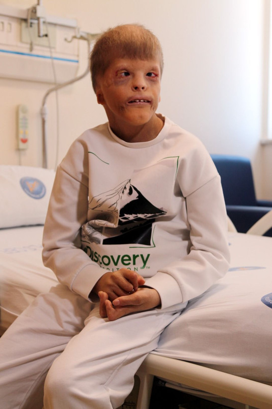 Gözleri kurtarılan Myhailo'ya, şimdi kulak kepçesi yapılacak - Resim: 7