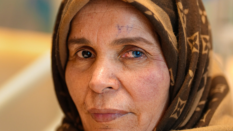 Kornea nakli geçiren Libyalı kadın, iki farklı göz rengine sahip oldu