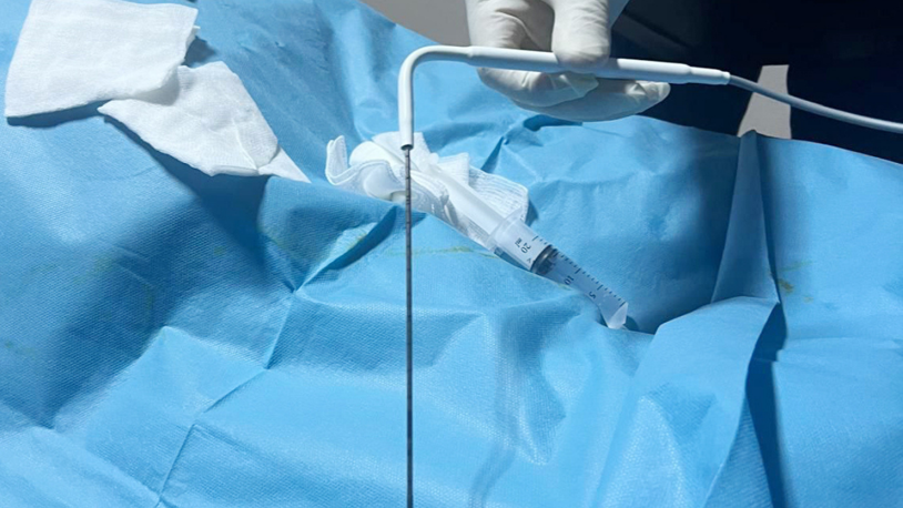 Ameliyatla alınamayan tümörler dondurularak yok ediliyor