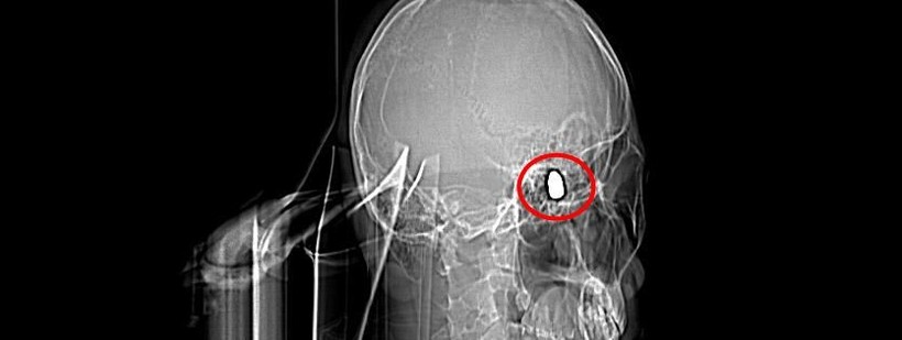 1,5 yıl önce başına isabet eden yorgun mermi hâlâ çıkarılamadı... Her gün ölüm korkusu yaşıyor - Resim: 6