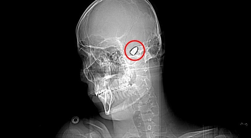 1,5 yıl önce başına isabet eden yorgun mermi hâlâ çıkarılamadı... Her gün ölüm korkusu yaşıyor - Resim: 10