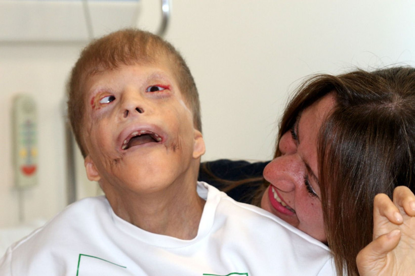 Gözleri kurtarılan Myhailo'ya, şimdi kulak kepçesi yapılacak - Resim: 5